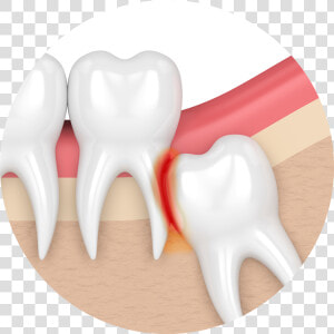 My Teeth Are Becoming Transparent Impaction Teeth Png   Impacted Wisdom Tooth  Png Download