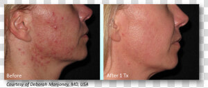 Manjoney   Infini Acne Scars Before And After  HD Png Download