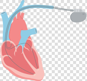 Systolic Romeo Landinez Co   Heart Failure Png  Transparent Png