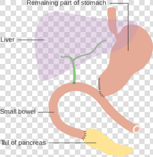 Pancreaticoduodenal Resection  HD Png Download