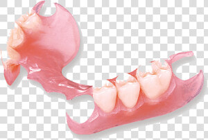 Flexi Partial Denture  HD Png Download