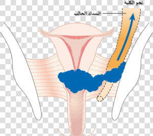 Diagram Showing Stage 3b Cervical Cancer Cruk 226 ar   Cervical Cancer Causing Hydronephrosis  HD Png Download