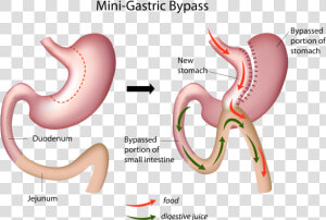 Mini gastric Bypass  HD Png Download