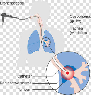 Lung Cancer Is The Leading Cause Of Death Due To Cancer  HD Png Download