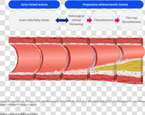 Atherosclerotic Lesion Development   Atherosclerotic Lesions  HD Png Download