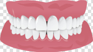 Invisalign Gap Teeth Missing Tooth  HD Png Download