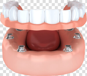 Implant Supported Model Brownstown  Mi   Snap Dentures  HD Png Download