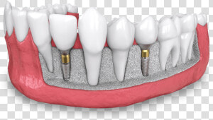 Dental Implant Model Dana Point Ca   Dental Implant  HD Png Download