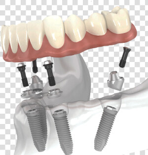 All On 4 Dental Implants   All on 4  HD Png Download