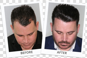 Hair Transplant Los Angeles  HD Png Download