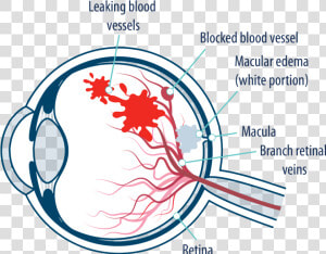 Eye With Macular Edema Following Retinal Vein Occlusion   Edema Macular Png  Transparent Png