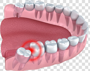 Wisdom Teeth Impacted   Teeth Are Wisdom Teeth  HD Png Download