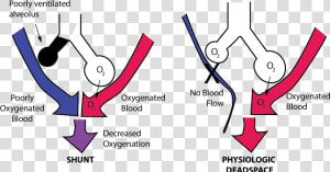 Imbalance Between Perfusion And Ventilation Is Called   Pulmonary Shunt  HD Png Download