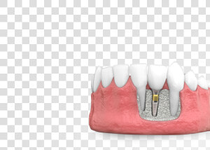 Dental Implants   Marking Tools  HD Png Download