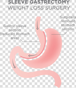 Gastric Sleeve Surgery Procedure   Gastric Sleeve Surgery  HD Png Download