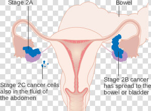 Stage 1 Ovarian Cancer Staging  HD Png Download