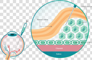 Illustration Of The Rpe65 Gene Delivery Method   Luxturna Mechanism Of Action  HD Png Download