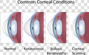 Common Corneal Conditions   Keratoconus And Astigmatism  HD Png Download