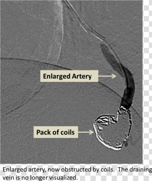 Avm 2   Pulmonary Avm Embolization  HD Png Download