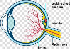 Picture Of Effects Of Wet Amd On The Eye  Showing Leaking   Eye Retinal Blood Vessel  HD Png Download