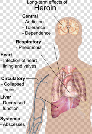 Long Term Effects Of Heroin  HD Png Download