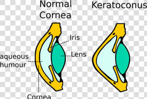 Kerataconus Image   Diagram Of Keratoconus  HD Png Download