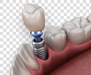 Dental Implants   Implant Dental Png  Transparent Png