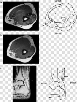 L Arm Mri Axial  HD Png Download