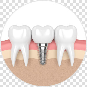 Dental Implant Illustration   Dental Implants  HD Png Download