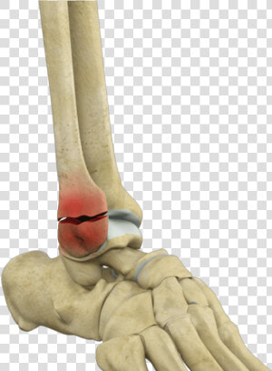 Ankle Fracture Repair Los Angeles   Fractured Ankle  HD Png Download