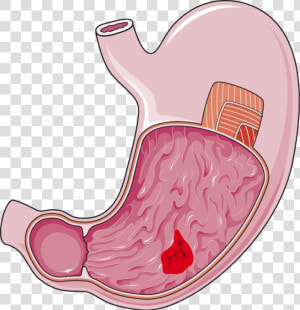 Stomach Ulcer Png  Transparent Png