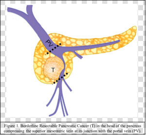 Tumor Borderline De Pancreas  HD Png Download