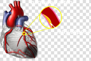 Moderate   Blocked Heart Arteries  HD Png Download