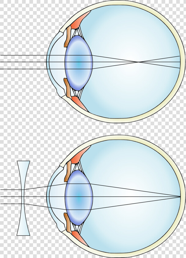 Myopia Mcat  HD Png DownloadTransparent PNG