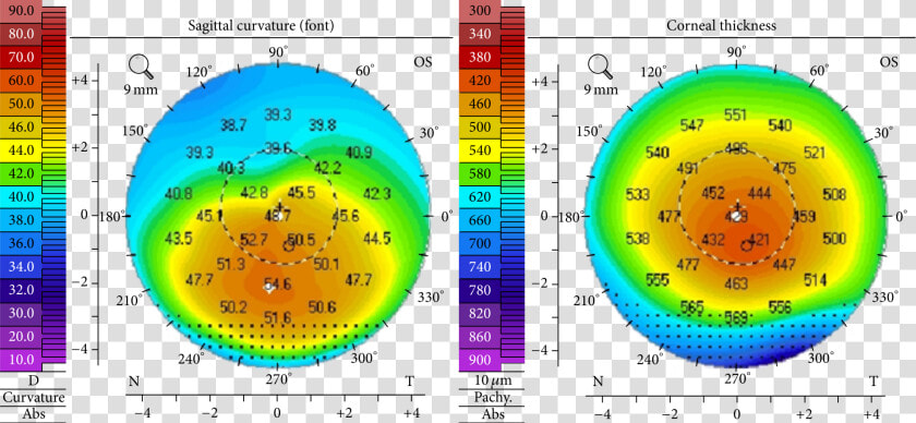 Corneal Topography Keratoconus  HD Png DownloadTransparent PNG