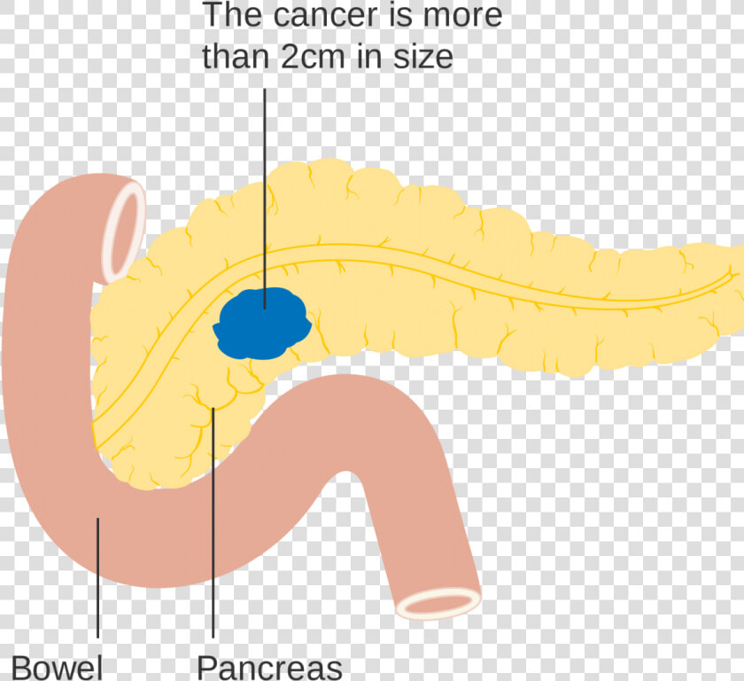 Pancreatic Cancer  HD Png DownloadTransparent PNG