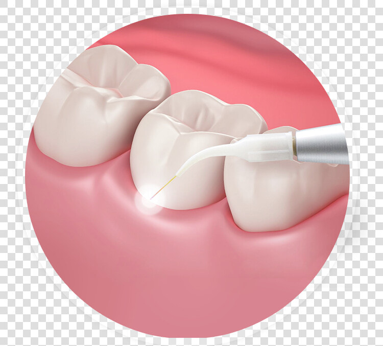 Transparent Laser Mouth   Gums  HD Png DownloadTransparent PNG