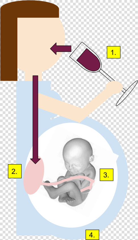 Fetal Alcohol Syndrome Gif  HD Png DownloadTransparent PNG