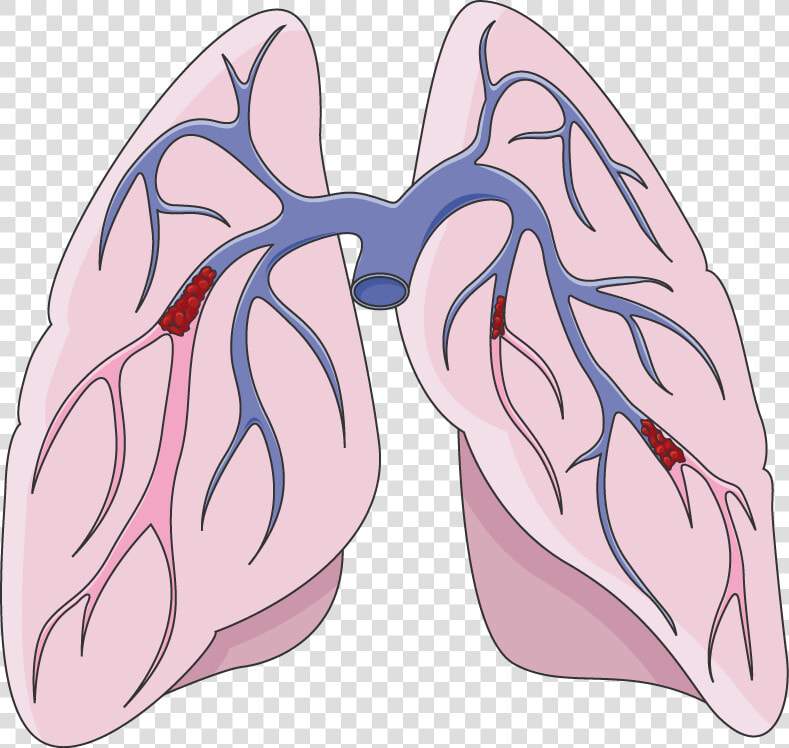 Pulmonary Embolism Clipart  HD Png DownloadTransparent PNG