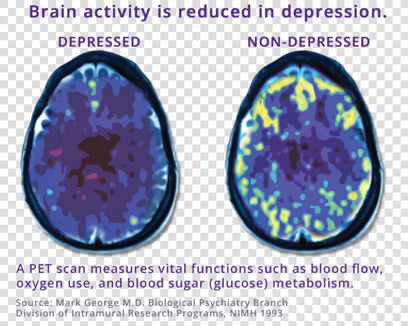 Pet Scan Comparing Depressed Brain To Non depressed   Tms Depression  HD Png DownloadTransparent PNG