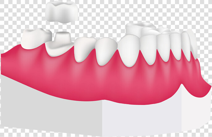 Tooth Clipart Crown Clipart Royalty Free Stock Dental  HD Png DownloadTransparent PNG