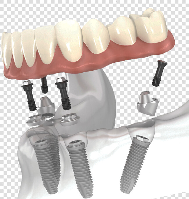 All On 4 Dental Implants   All on 4  HD Png DownloadTransparent PNG