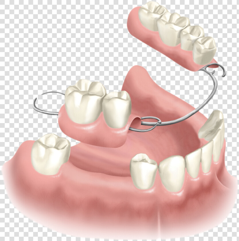 Dental Partial Denture  HD Png DownloadTransparent PNG