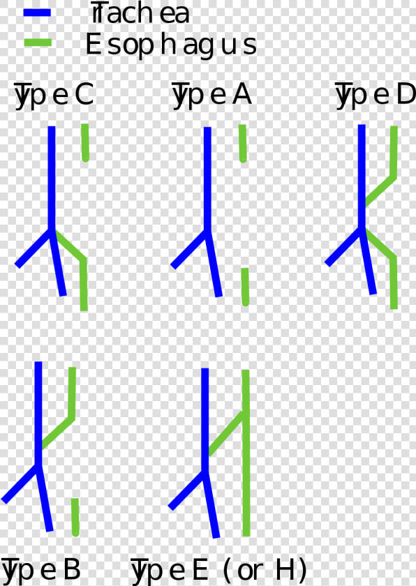 Te Fistula Types  HD Png DownloadTransparent PNG