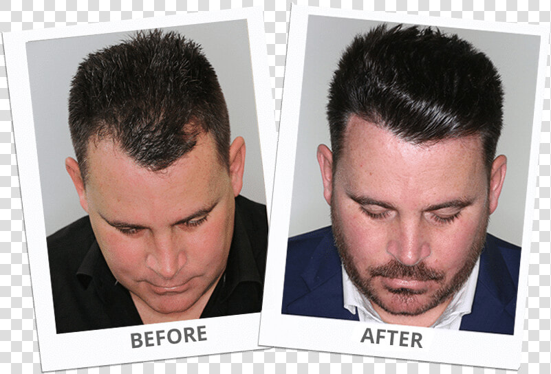 Hair Transplant Los Angeles  HD Png DownloadTransparent PNG