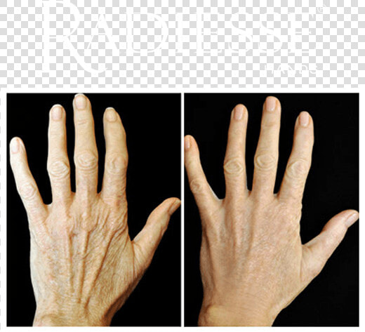 Before And After Treatment With Radiesse® Hands   Ácido Hialurônico Nas Mãos  HD Png DownloadTransparent PNG