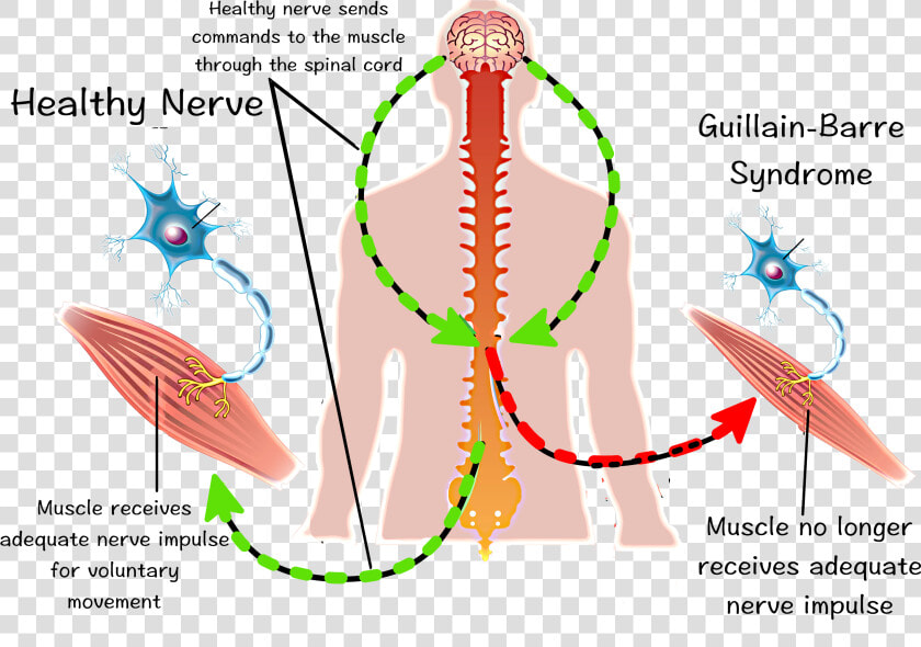 Exercise Guillain Barre Syndrome  HD Png DownloadTransparent PNG