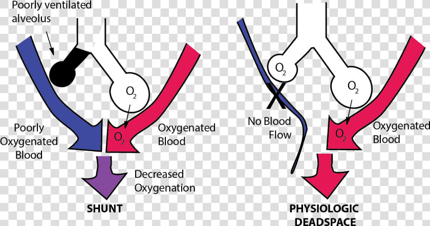 Imbalance Between Perfusion And Ventilation Is Called   Pulmonary Shunt  HD Png DownloadTransparent PNG