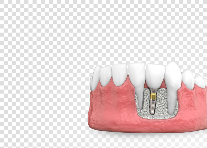 Dental Implants   Marking Tools  HD Png DownloadTransparent PNG