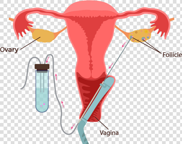 Ivf Process Step By Step   Ivf Egg Collection Process  HD Png DownloadTransparent PNG